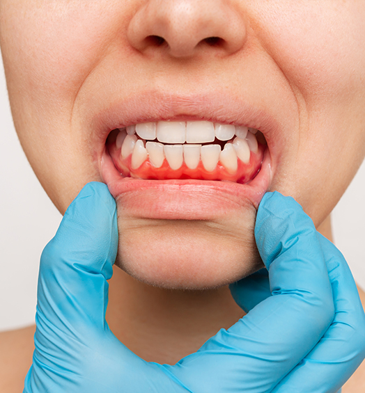 periodontal (gum) surgery (1)
