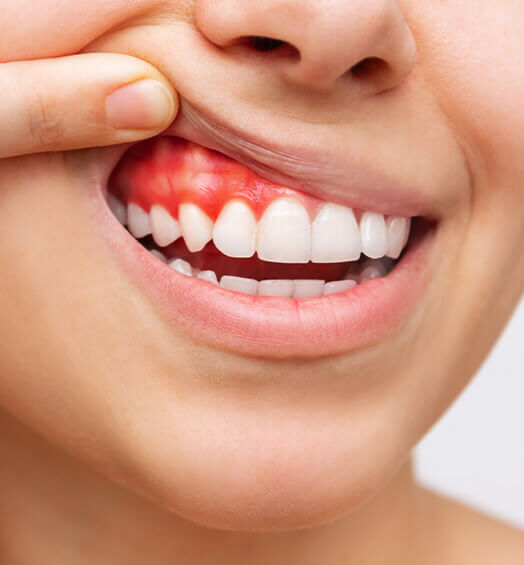 signs that you may have gum disease include (1) (1)