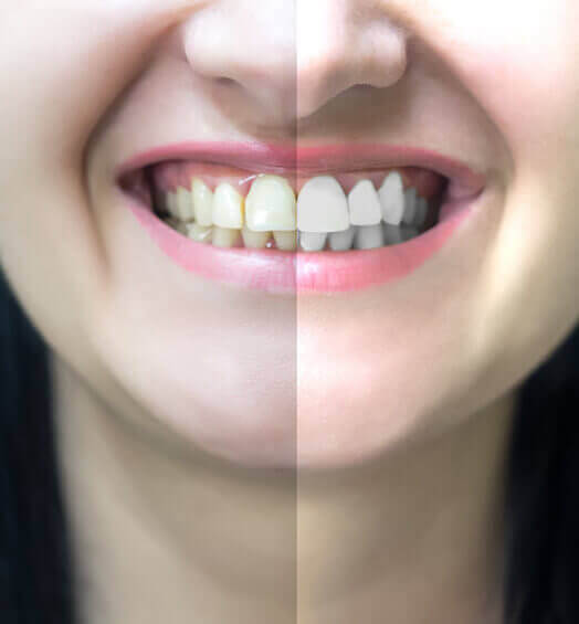 tooth colored restorations (1) (1)